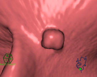 大腸3D-CT検査画像