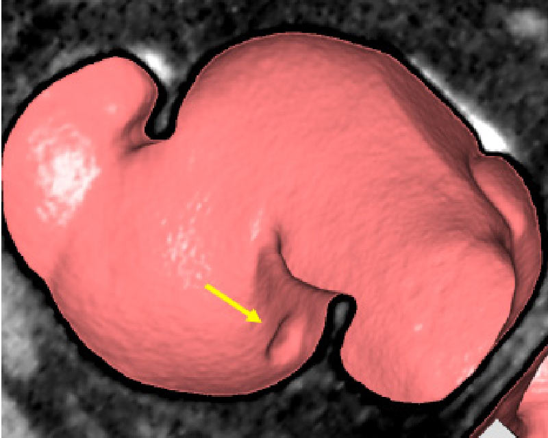 大腸3D-CT検査画像